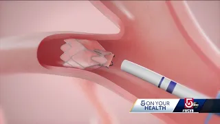 Hospital offering new treatment for people living with COPD