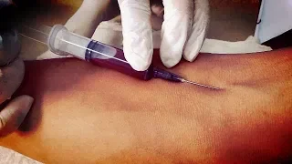 Safe and  effective blood  draw by syringe | blood collection procedure best ever
