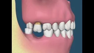 Perda dental e suas consequências - vídeo 1