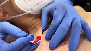 I HAVE NEVER SEEN A CYST POP LIKE THIS!  | Black INK Steatocystoma - Dr. Derm