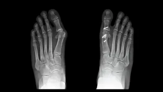 What Kind of Bunion Surgery is Right for Me?