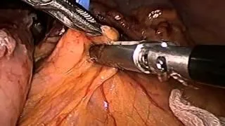 Spleen preserving laparoscopic distal pancreatectomy