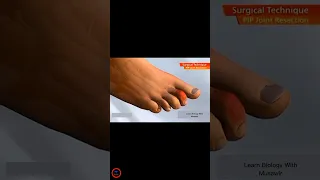 Hammertoe procedure animation _ #shorts