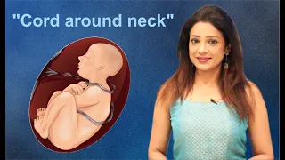 बच्चे के गले में नाल हो तो Cesarean जरुरी हैं?