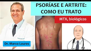 Tudo que você queria saber sobre psoríase e artrite: sintomas, diagnóstico e tratamento.