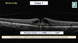 How to treat Macular Hole (English)