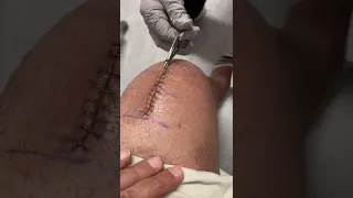 Taking out staples- two week after surgery
