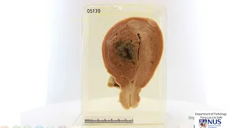 Uterus - Adenomyosis