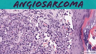 Angiosarcoma: 5-Minute Pathology Pearls