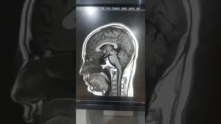 MRI Brain 🧠 Anatomy in Sagittal image...(বাংলায়)