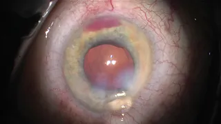 difficult trainee phacotrabectome in severe PEX, corneal edema, small pupil#2