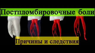 Почему болит зуб после пломбировки корневых каналов?