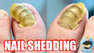 MOST INTERESTING TOENAILS IN THE WORLD???