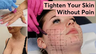 Is This the End of Botox? Why is Thermage Winning the Game!