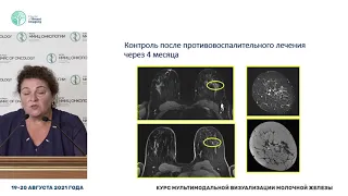 Особенности дифференциальной диагностики воспалительных изменений молочной железы и рака