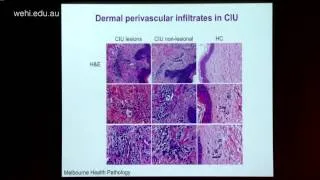 Auyeung P (2014): Autoimmune responses in chronic idiopathic urticaria