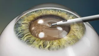 Dr. Jon Weyer explains: Refractive Lens Exchange