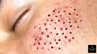 Satisfying Extractions | Relaxing! Blackheads X Whiteheads | NILUFER ESTHETICS SPA