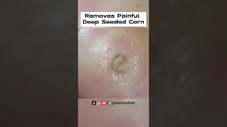 2023 - Podiatrist Removes Painful Deep Seeded Corn From Sole Of Feet [ MISS FOOT FIXER ]