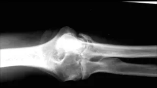 Rheumatoid Arthritis of Elbow on X ray