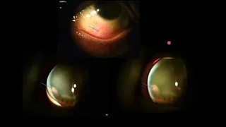 Uveitis Unraveled Case 2 - A Case of Ciliary Body Mass