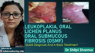 Quick Diagnosis And Basic Treatment of Leukoplakia, Lichen Planus and Oral Submucous Fibrosis (OSMF)