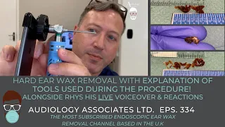 HARD EAR WAX REMOVAL EXPLAINING TOOLS USED DURING PROCEDURE - EP 334