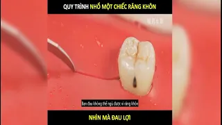 Nhổ một chiếc Răng Khôn đau đến mức nào | LT Review