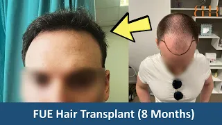 2950 FUE Hair Transplant Results (0-8 Months) by Dr.Kostis (BHR Clinic)