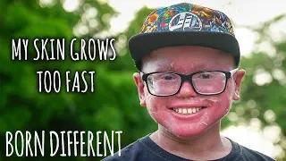 The Teen Whose Skin Grows Too Fast | BORN DIFFERENT