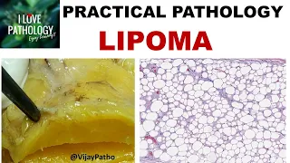 LIPOMA : Gross & Microscopy, Types and variants