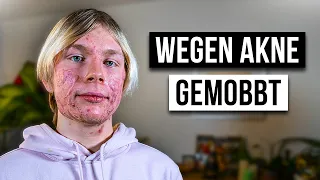 Wie ist das AKNE ZU HABEN?