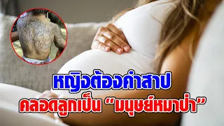 ฮือฮา! สาวคลอดลูกเป็น “มนุษย์หมาป่า” เชื่อถูกต้องคำสาปเพราะของที่กินตอนท้อง หมอเผยความจริง : RECAP