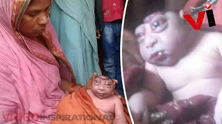 Baby Born With Extremely Rare Deformity Is Rejected By His Mum 'For Looking Like An Alien'