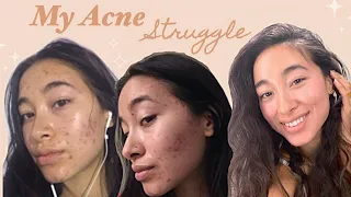 How I Cleared My Skin ( & the inner journey)