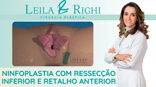 Ninfoplastia com Ressecção Inferior e Retalho Anterior