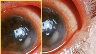 A Visual Guide to Uveitis