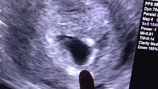 Sonogram: 6 weeks pregnant !