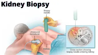 How to do Kidney Biopsy?|Ultrasound guided Kidney Biopsy|Unexplained Renal Failure|@Med For All