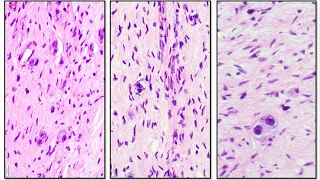 Neuroblastoma and Ganglioneuroma  - Adventures in Neuropathology