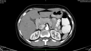 TMT: Pancreatic Imaging by Dr Ankur Shah: Protocols