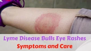Lyme Disease Bulls Eye Rashes Symptoms and Care