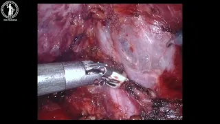 Komplett extraperitoneale nephroureterektomie roboterassistierte technik ohne positionsveränderu