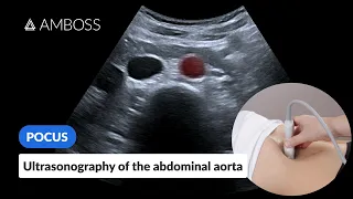 Point of Care Ultrasound of the Abdominal Aorta - AMBOSS Video