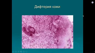 Патанатомия. Лекция №12:"Инфекции детского возраста (часть 2). ДМН, проф Кирьянов Н.А. 24.04.2020