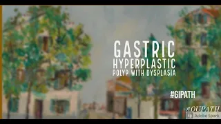 Gastric Hyperplastic Polyp