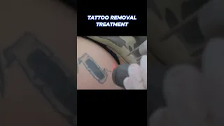 Tattoo removal first treatment #tattooremoval #satisfying #shorts