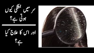 Dandruff Treatment at home in urdu || Dandruff Khatam Karne Ka Tarika in urdu