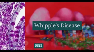 Whipple's Disease