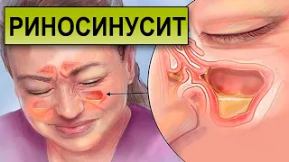 РИНОСИНУСИТ. Чем опасно заболевание